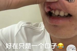 玉昆后卫晒受伤照：提前换下因争头球撞到了 视野模糊看不清&头晕